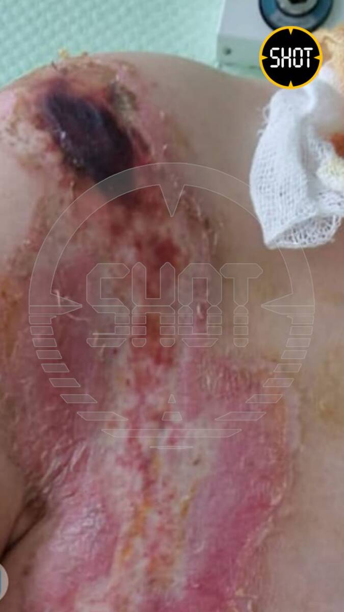 В Челябинске туристка чудом выжила после удара молнии qqkidzqidexidrhkmp