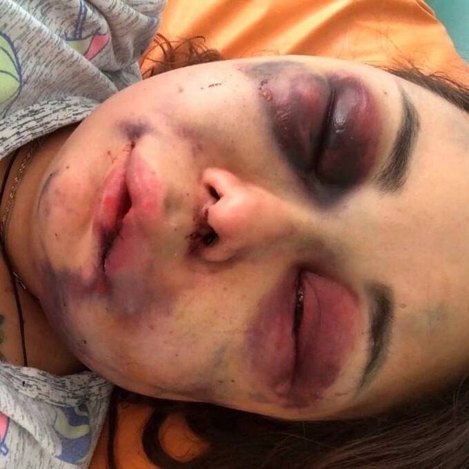 Мужчина в Челябинске избил девушку до неузнаваемости из-за отказа от интима