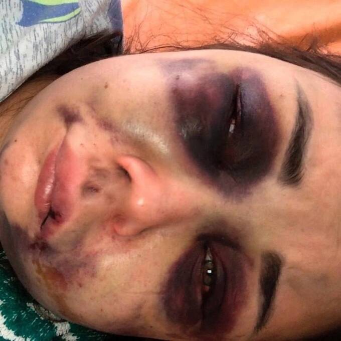 Мужчина в Челябинске избил девушку до неузнаваемости из-за отказа от интима