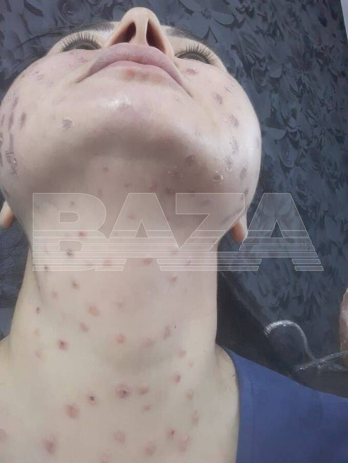 В Уфе косметолог осуждена за некроз тканей у клиентки после мезотерапии dzeiquhidrdikkkmp