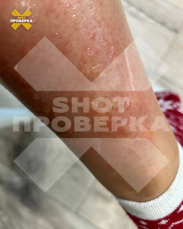 После первой процедуры лазерной эпиляции москвичка попала в больницу с ожогами