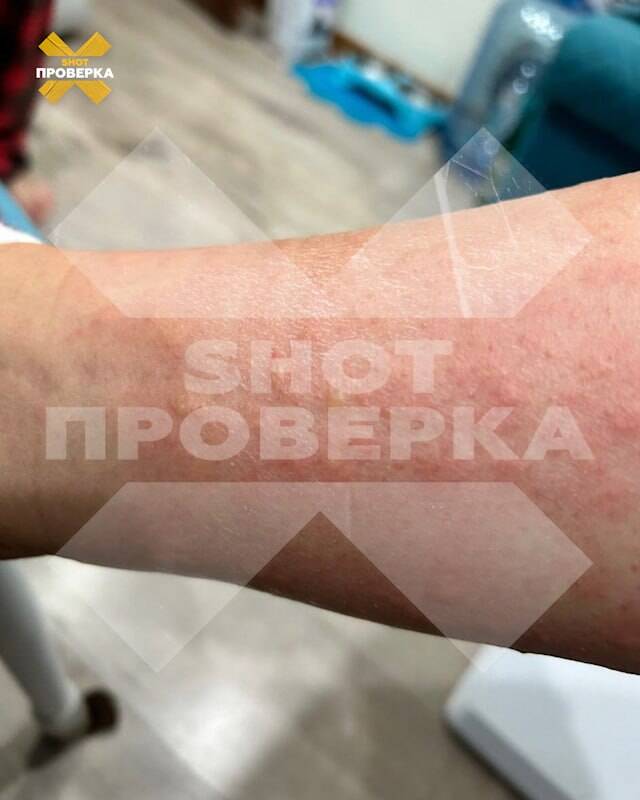 После первой процедуры лазерной эпиляции москвичка попала в больницу с ожогами