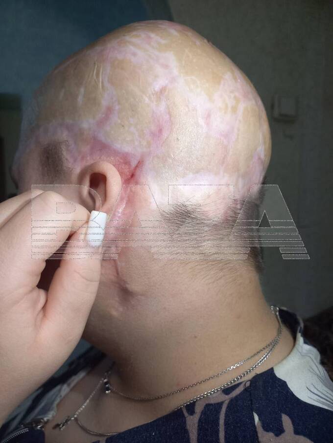 В Самаре девушка потеряла скальп на производстве